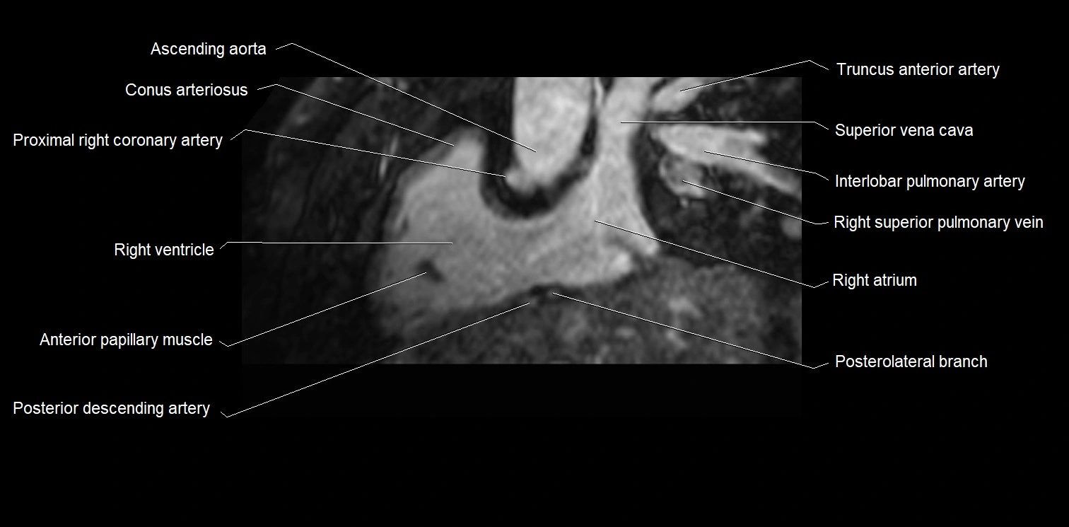 MRI heart and coronary arteries two chamber(sagittal)  anatomy image 13.webp